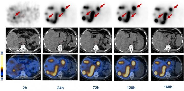 SPECT/CT of a 45-year-old Male Patient with Advanced NETs and Multiple Liver Metastases