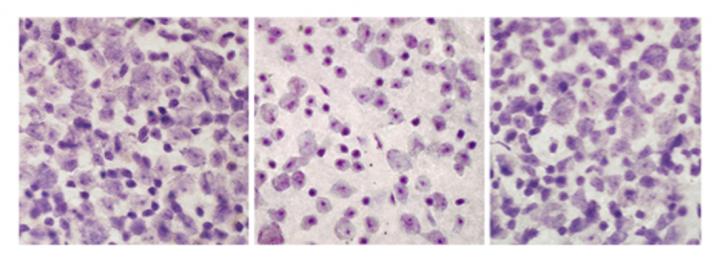 Childhood Dementia: Degeneration Can Be Slowed Down