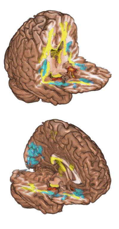 Brain Features Point to Addiction Vulnerability (4 of 5)