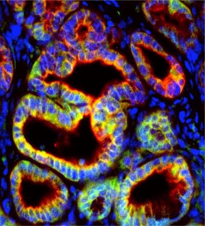 Pancreatic Cancer Cells