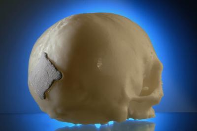 Bone Replacement from Laser Melting
