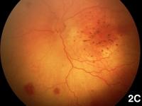 Fundus Photo of Retinal Hemorrhaging in Baby with Zika-Induced Microcephaly