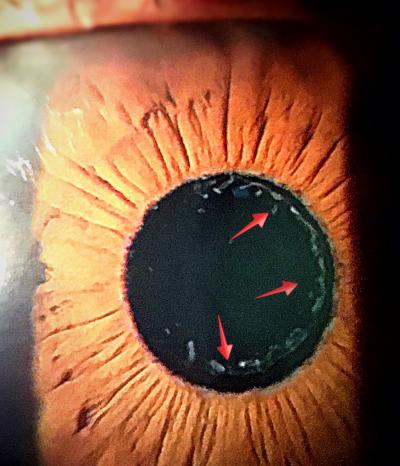 Eye of a patient with exfoliation syndrome.