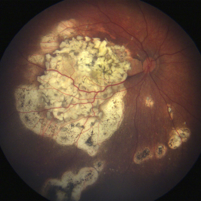 Researchers discover new molecular driver of retinoblastoma