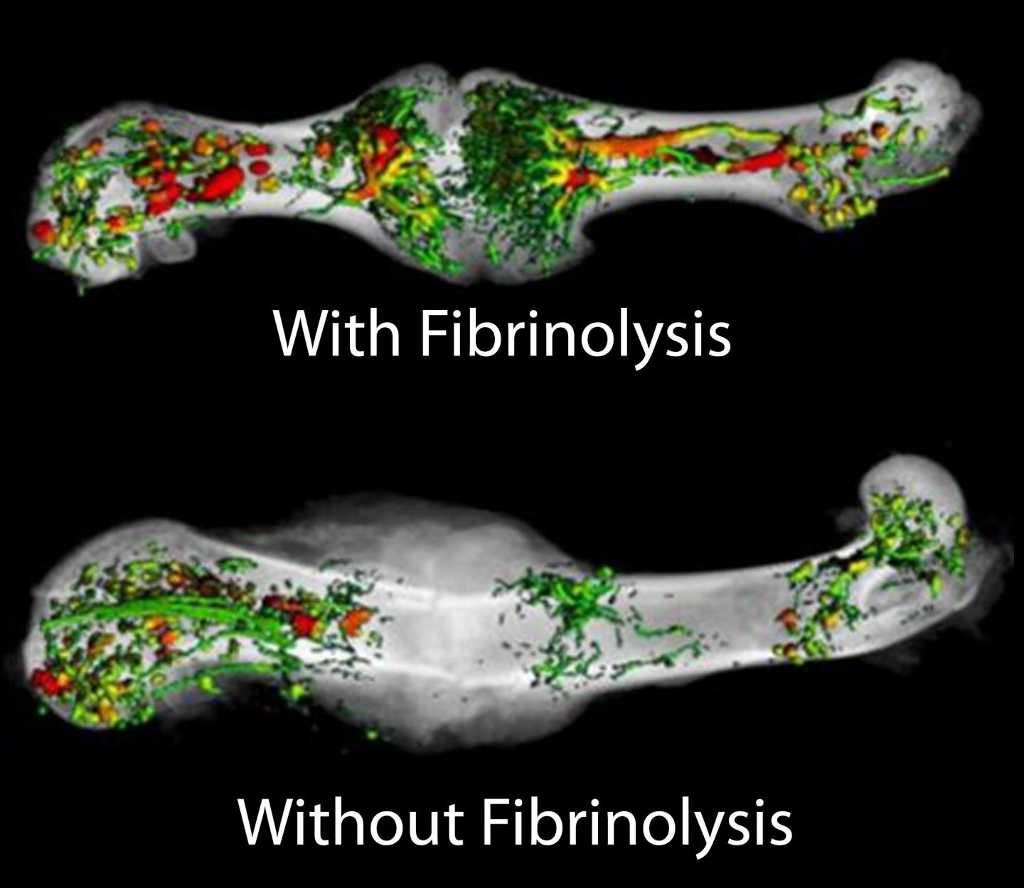 Fibrin Clearance Required for Fracture Healing