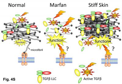 Genetic Link between 'Stiff Skin' and Scleroderma