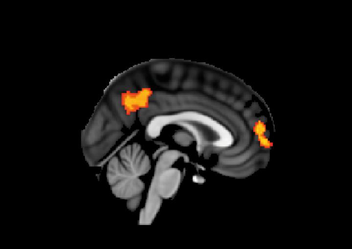 Abnormal Brain Activation