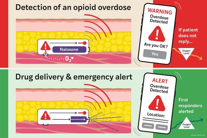 Schematic illustration of the implantable Naloximeter device to stop opioid overdose