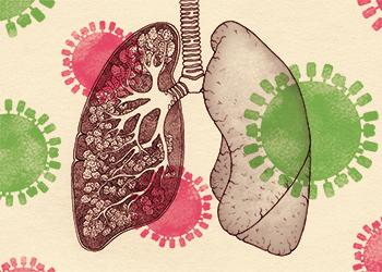 Flu damage on the lungs