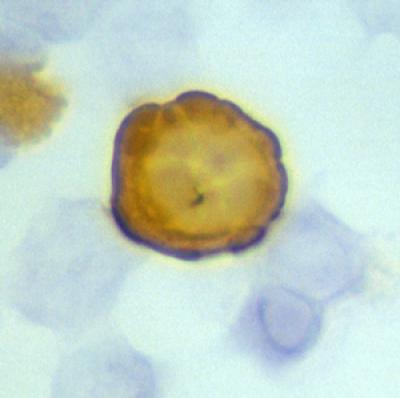 Burn Scar in Mature Tree