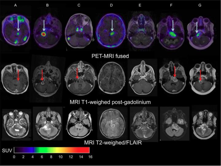 MRI and PET-MRI Fusion Images of Patients with DIPG