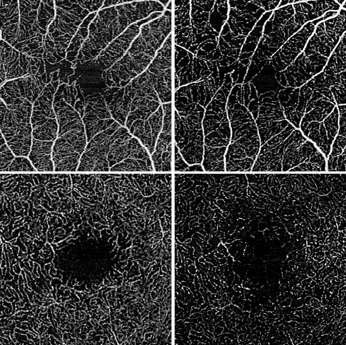 Optical coherence tomography angiography showing ocular vascular perfusion in intermediate uveitis