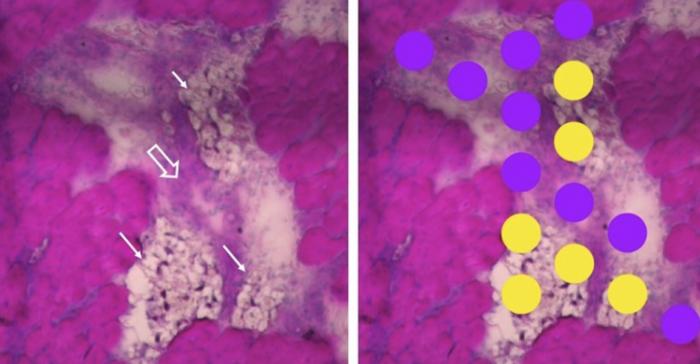 The mechanisms of wooden breast syndrome