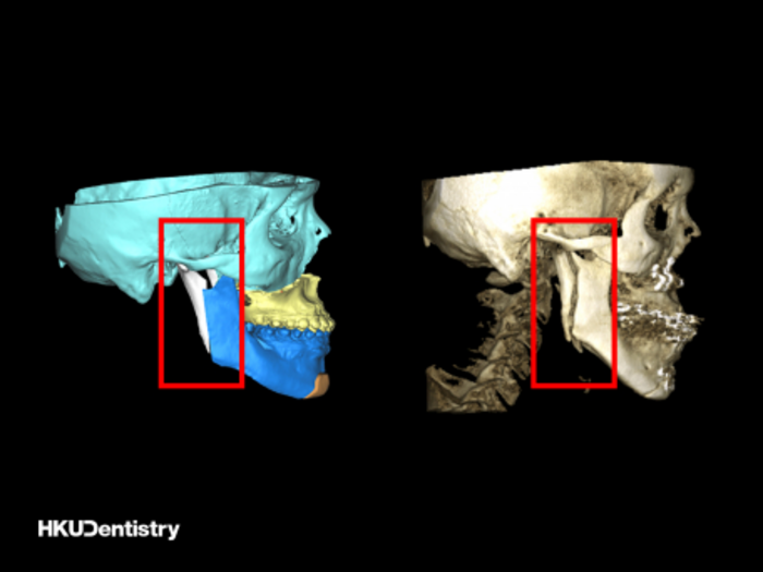 Intraoral vertical ramus osteotomy