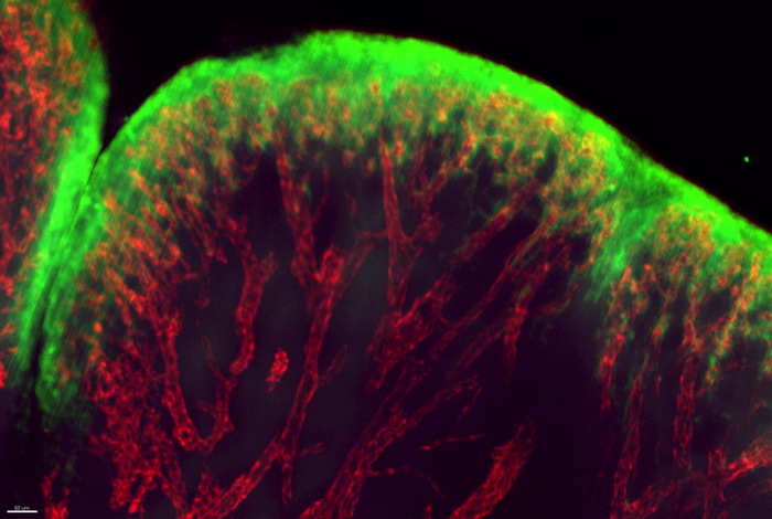 Rheumatoid Arthritis Flare up IMAGE EurekAlert Science News Releases