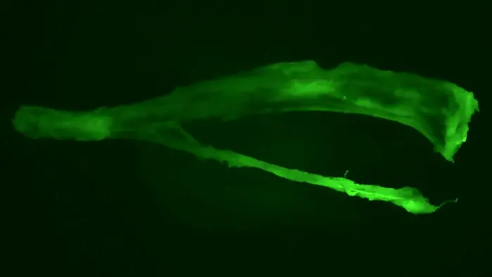 Prostate cancer metastasis in tibia