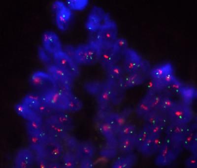 Pancreatic Tissue Sample Stained to Highlight HER2 Gene