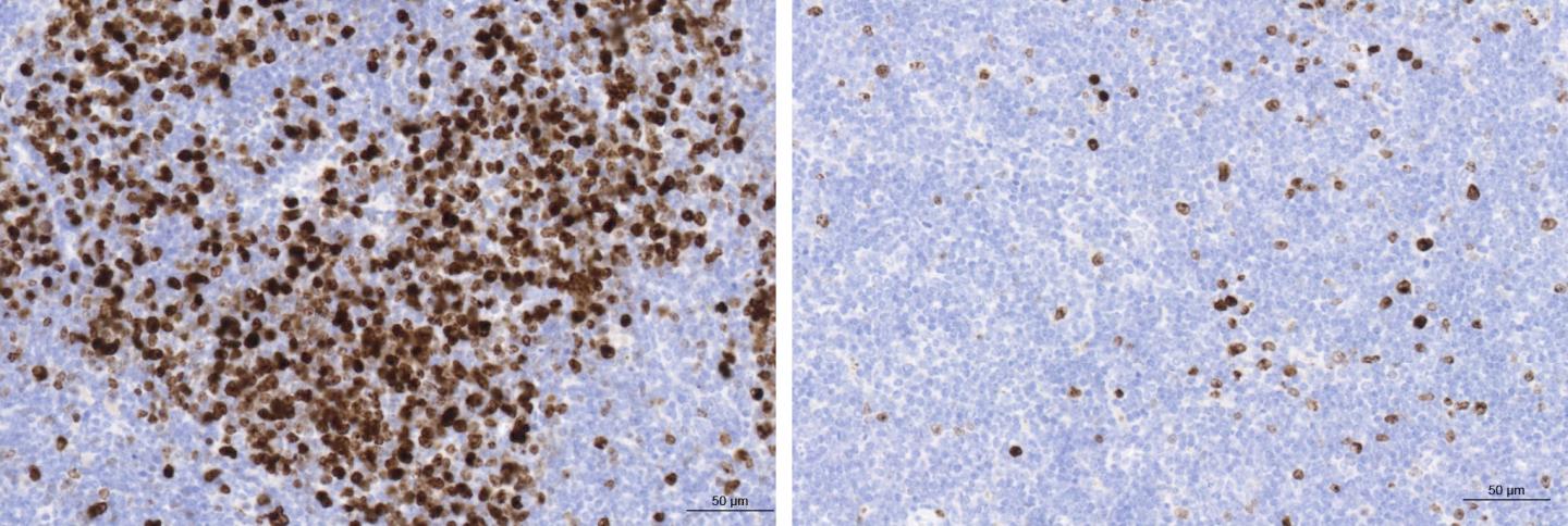 Follicular Lymphoma with Abundant Multiplying B Cells