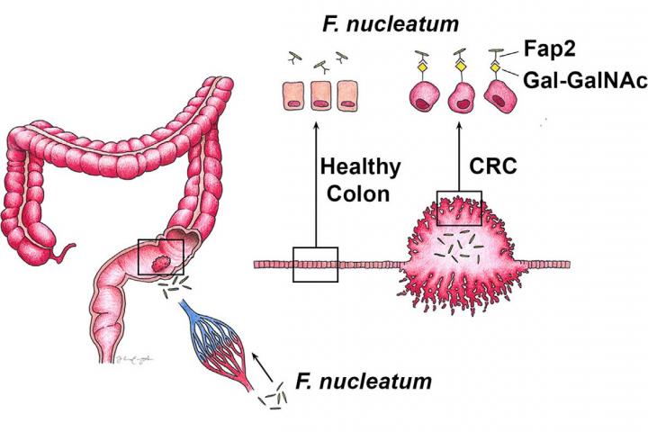 Fusobacterial Lectin and Colon Cancer