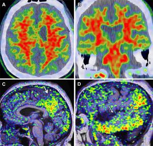 Amyloid and τ PET imaging in AD in a 72-year-old man with AD dementia.