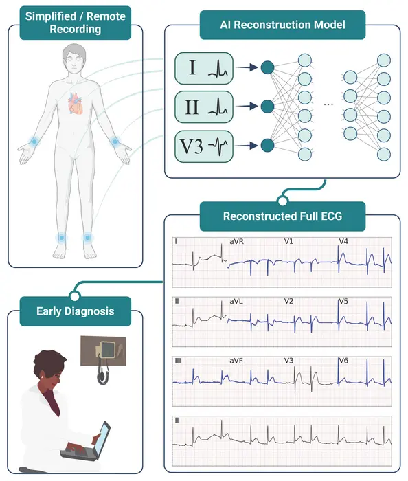 New AI tool simplifies heart monitoring: Fewer leads, same accuracy