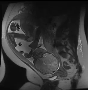 MRI scan of healthy third-trimester fetus