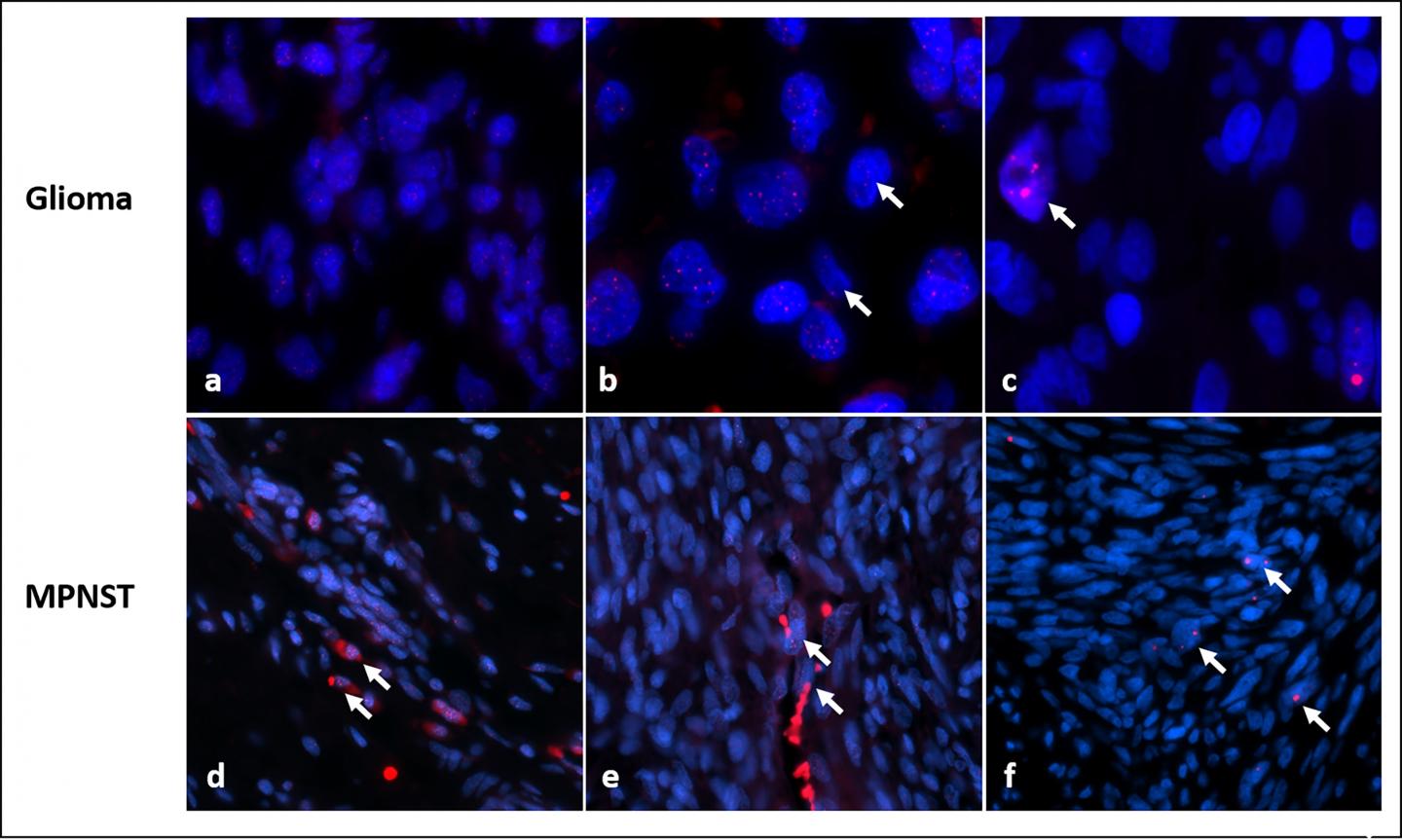 Elomere Alterations in NF1-Solid Tumors