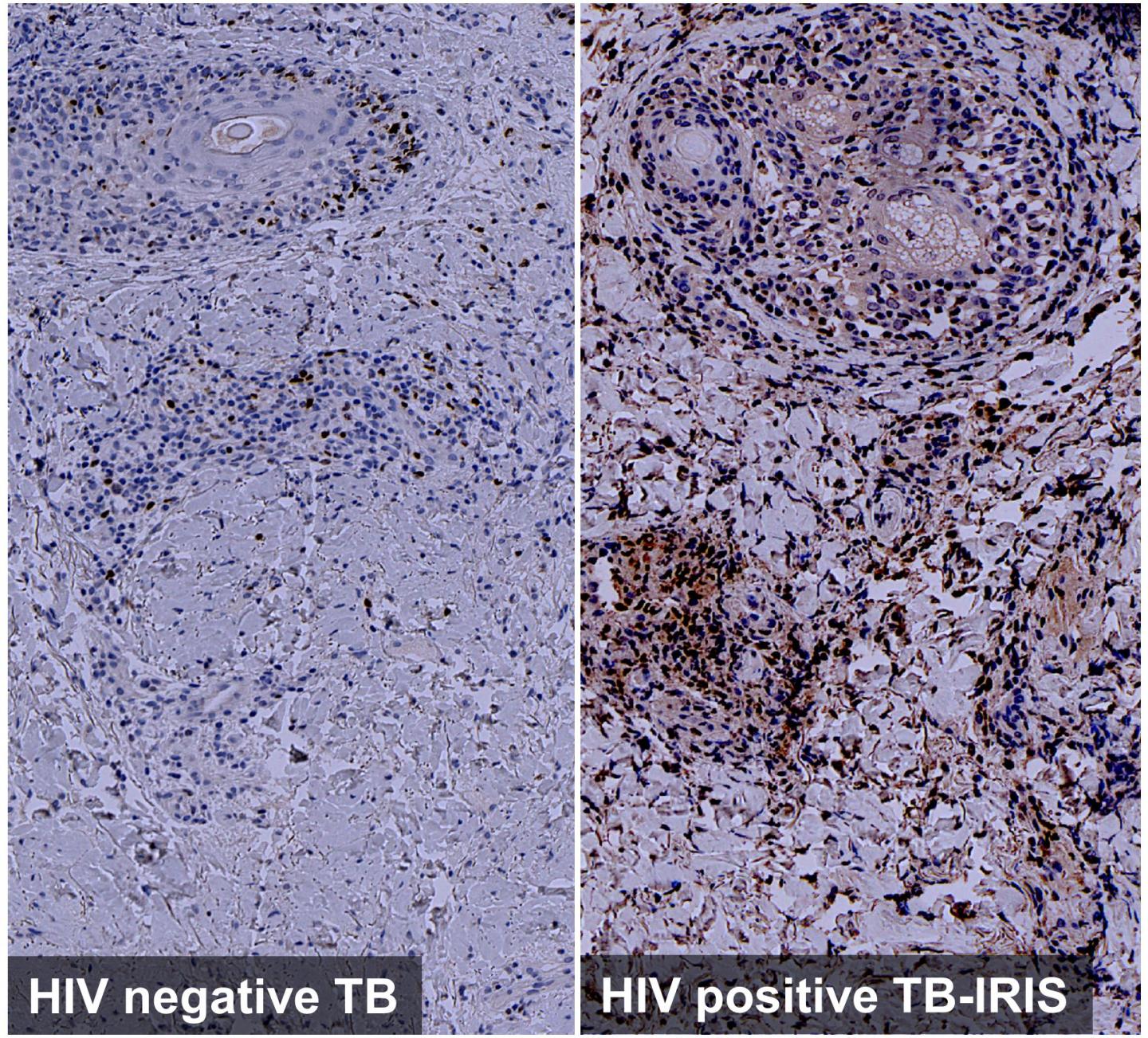 Exaggerated IRF4 Expression 