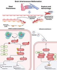 Mechanisms of Mutation-Induced Pathogenesis in sporadic AVMs.