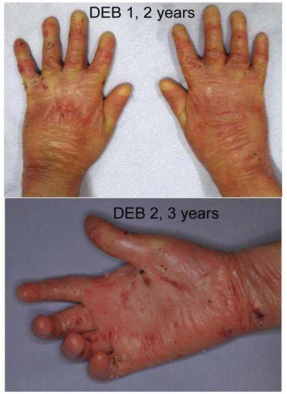 Higher Inflammation & Protein Turnover in Skin Disorder DEB