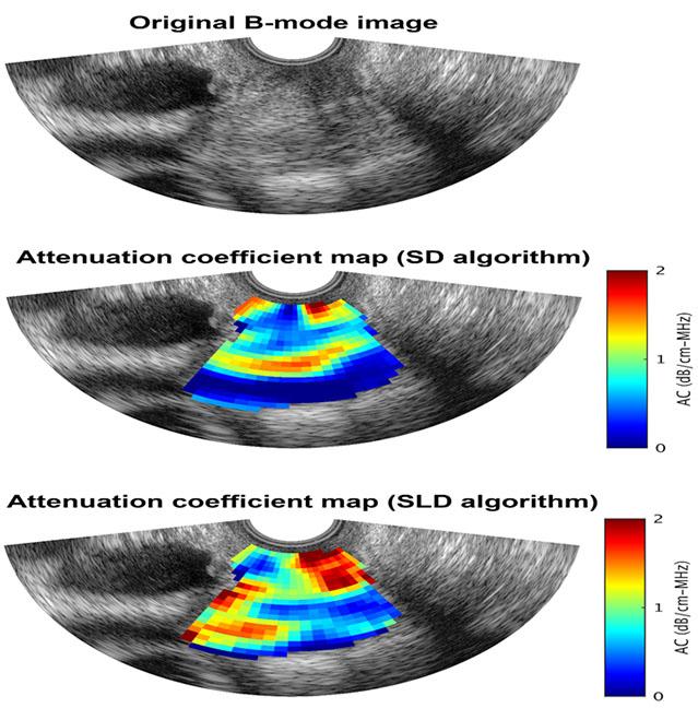 a B-mode image demonstrating a cervical length measurement