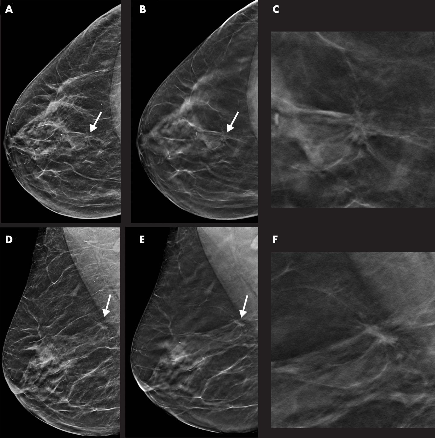 Breast cancer detection: advantage DBT •