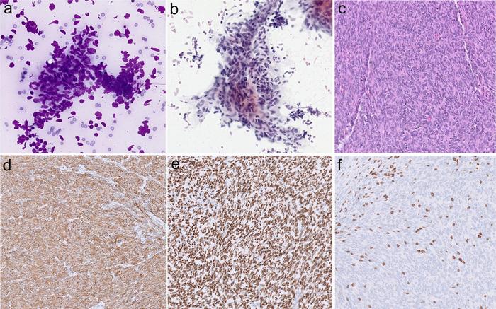 Type A thymoma