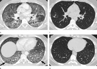 Lung Injuries from Vaping Have Characteristic Patterns on CT