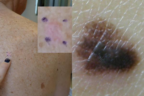Amelanotic and Pigmented Melanoma