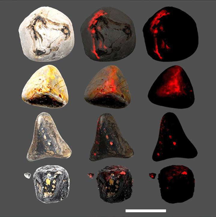 DNA Patches on Gallstones