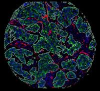 Molecular cartography of breast cancer