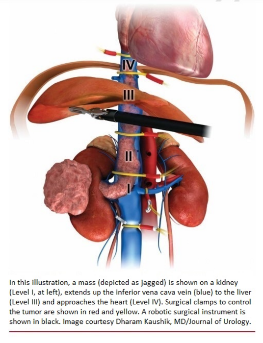 Anatomy of the kidneys, liver and heart with the inferior vena cava, and surgical intervention to treat cancer