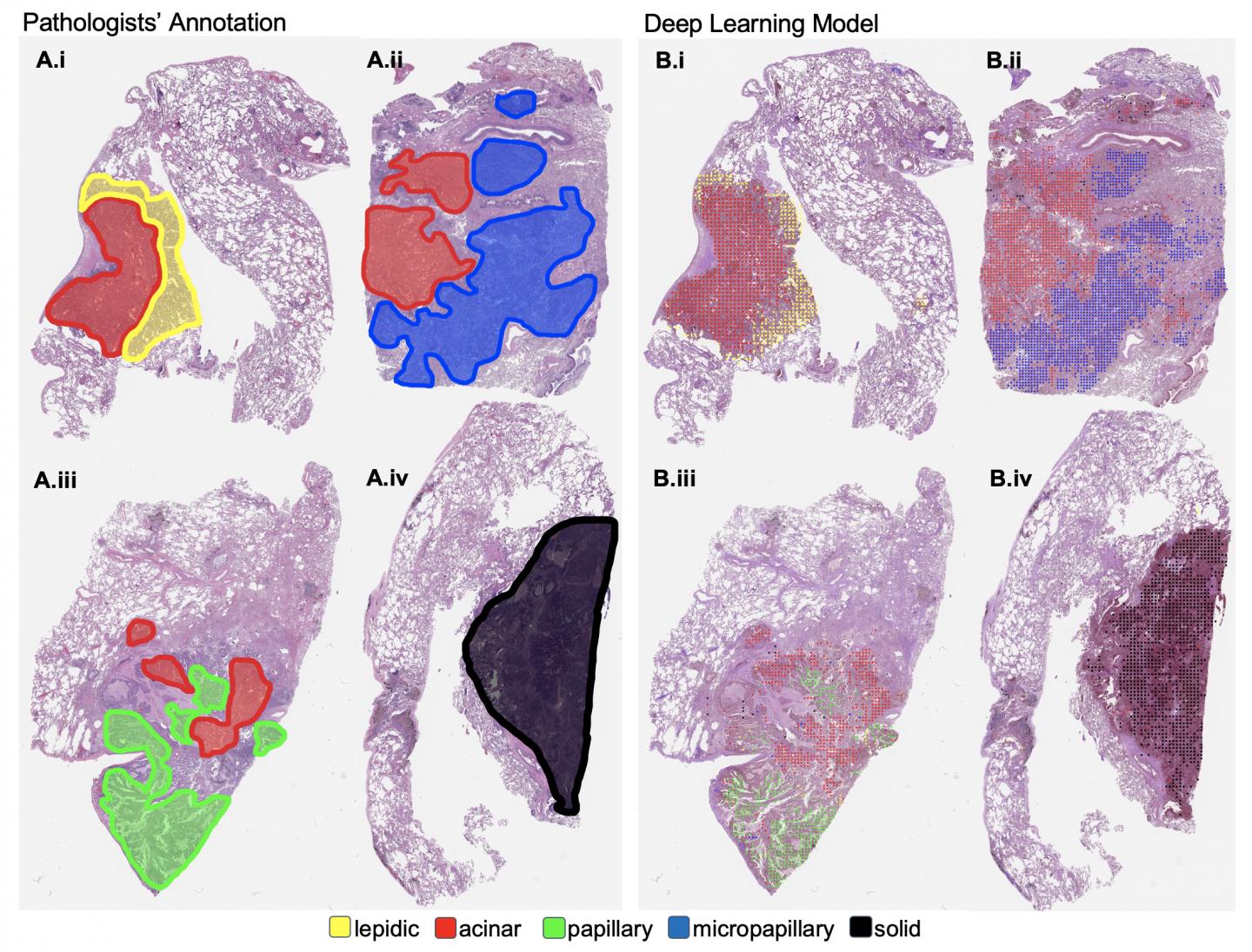 Visualization of Human and Machine Assessment of Lung Cancer Slides