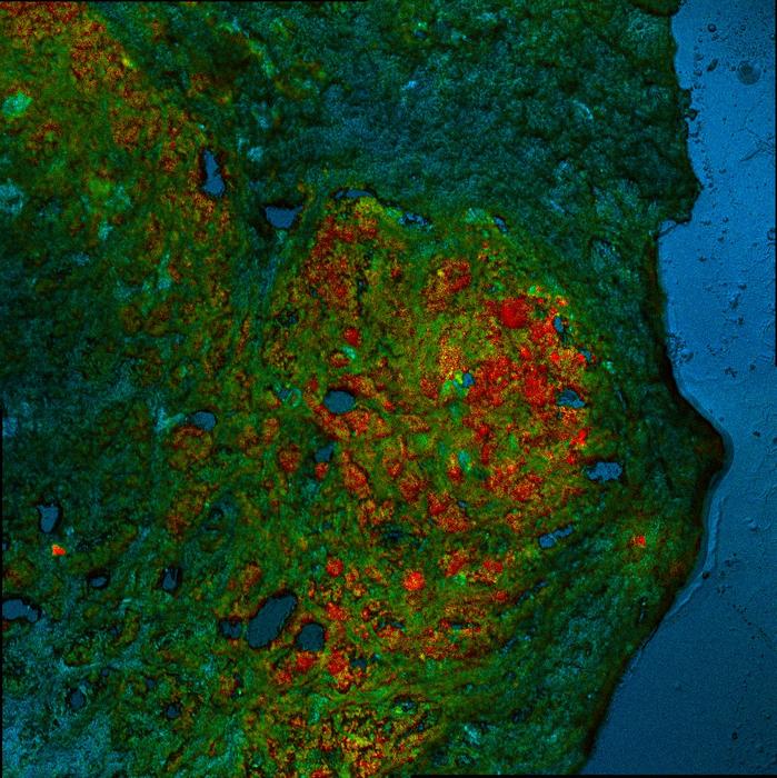 Lymph Metastasis Colorectal Cancer Cells