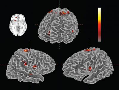 fMRI Scan Showing Real-time Changes in Neural Activity