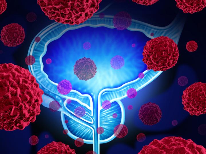 Prostate Cancer