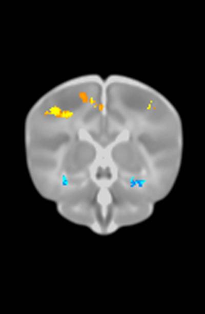 Brain Image with Risk Variants