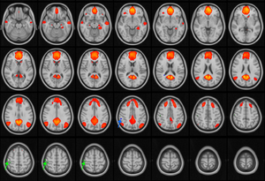 Multiple Concussions Can Disrupt Brain Connectivity in Teens