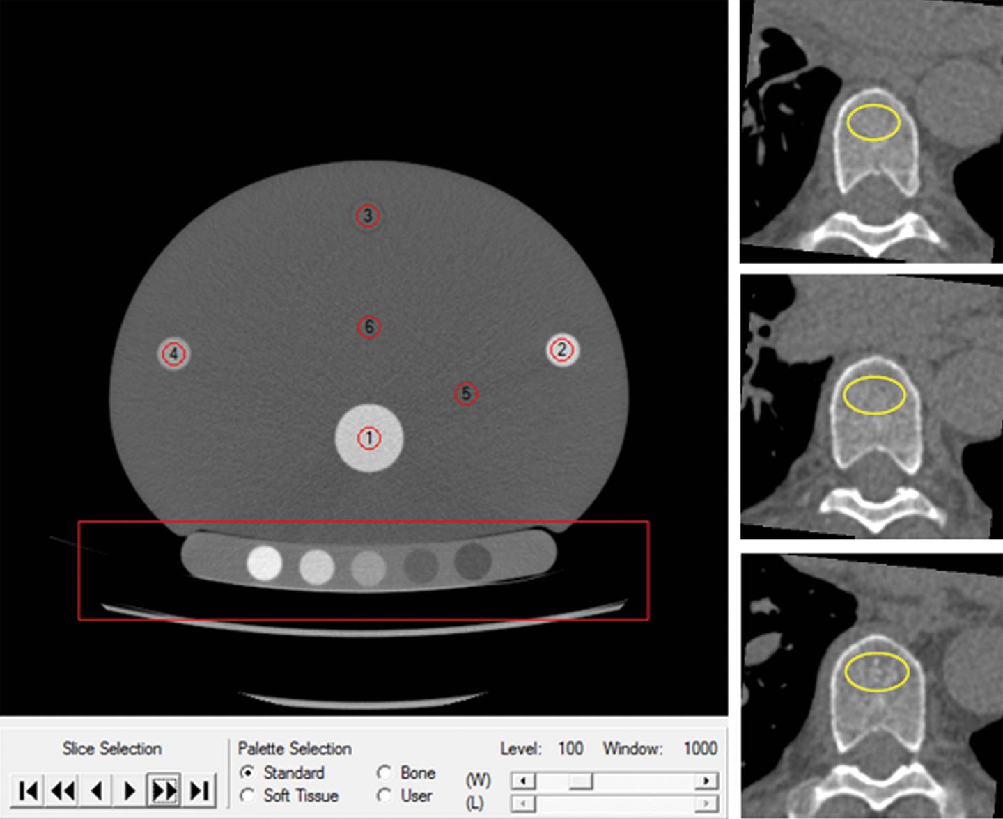 Cardiac CT Can Double as Osteoporosis Test