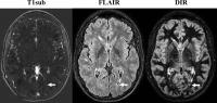 Axial MR Images in 27-year-old Man with Relapsing-Remitting Multiple Sclerosis