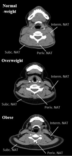 the accumulation of fat in different neck deposits