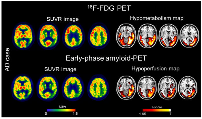 The comparability of early-phase amyloid-PET and FDG-PET images at the single-subject level.
