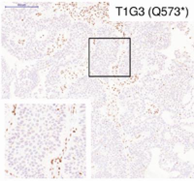 Bladder Tumor Sample Containing Mutations in the STAG2 Gene