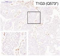 Bladder Tumor Sample Containing Mutations in the STAG2 Gene